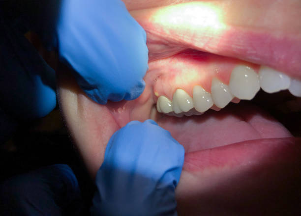 Best Emergency Root Canal Treatment in Cheney, KS